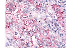 Anti-USP4 / UNP antibody IHC of human Lung, Non-Small Cell Carcinoma. (USP4 Antikörper  (N-Term))