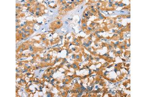 Immunohistochemistry of Human thyroid cancer using CXCL14 Polyclonal Antibody at dilution of 1:40 (CXCL14 Antikörper)