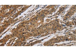Immunohistochemistry of paraffin-embedded Human gastric cancer tissue using Claudin 2 Polyclonal Antibody at dilution 1:50 (Claudin 2 Antikörper)