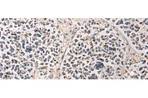 Immunohistochemistry of paraffin-embedded Human breast cancer tissue using PAIP1 Polyclonal Antibody at dilution of 1:80(x200) (PAIP1 Antikörper)