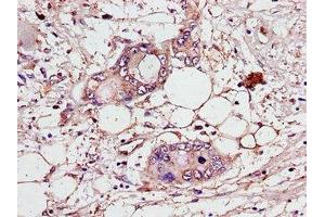 Immunohistochemistry of paraffin-embedded human pancreatic cancer using ABIN7147419 at dilution of 1:100 (CEP7 (AA 99-276) Antikörper)