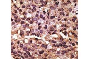 IHC analysis of FFPE human breast carcinoma tissue stained with the BNIP3 antibody (BNIP3 Antikörper  (AA 152-187))