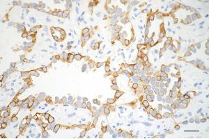 Immunohistochemistry was performed on paraffin-embedded human lung adenocarcinoma using CD8 alpha antibody (ABIN7797987), 1:200). (Rekombinanter CD8 alpha Antikörper)