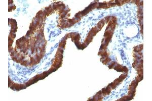 Formalin-fixed, paraffin-embedded human Ovarian Carcinoma stained with Cytokeratin 7 Monoclonal Antibody (KRT7/760 + OV-TL12/30) (Cytokeratin 7 Antikörper)