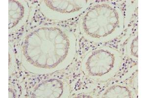 Immunohistochemistry of paraffin-embedded human colon cancer using ABIN7142353 at dilution of 1:100 (MRPL14 Antikörper  (AA 1-145))