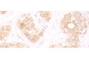 Immunohistochemistry of paraffin-embedded Human liver cancer tissue using TRMT1 Polyclonal Antibody at dilution of 1:25(x200) (TRMT1 Antikörper)