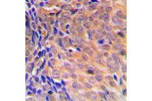Immunohistochemical analysis of COPS3 staining in human breast cancer formalin fixed paraffin embedded tissue section. (COPS3 Antikörper  (Center))