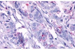 Anti-GPR124 antibody  ABIN1048704 IHC staining of human colon carcinoma, neoplastic cells. (GPR124 Antikörper  (N-Term))