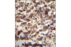 TFAM antibody immunohistochemistry analysis in formalin fixed and paraffin embedded human testis carcinoma followed by peroxidase conjugation of the secondary antibody and DAB staining. (TFAM Antikörper  (C-Term))