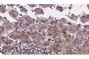 ABIN6273959 at 1/100 staining Human liver cancer tissue by IHC-P. (OR51M1 Antikörper  (C-Term))