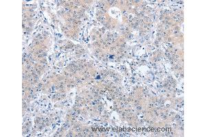 Immunohistochemistry of Human liver cancer using PARD6A Polyclonal Antibody at dilution of 1:60 (PARD6A Antikörper)