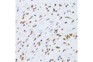 Immunohistochemistry of paraffin-embedded human gastric cancer using DDB1 Antibody. (DDB1 Antikörper)