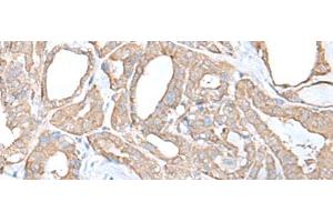 Immunohistochemistry of paraffin-embedded Human thyroid cancer tissue using C9orf116 Polyclonal Antibody at dilution of 1:55(x200) (C9ORF116 Antikörper)