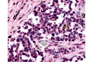 Anti-GPR182 / ADMR antibody IHC of human Lung, Small Cell Carcinoma. (G Protein-Coupled Receptor 182 Antikörper  (N-Term))