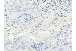 ABIN6254899 and ABIN6267063 at 1/100 staining human tongue carcinoma by IHC-P. (Histone H4 Antikörper  (H4K12ac))