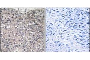 Immunohistochemistry analysis of paraffin-embedded human cervix carcinoma, using Inositol 1, 4, 5-trisphosphate R1 (Phospho-Ser1598/1588) Antibody. (ITPR1 Antikörper  (pSer1598))