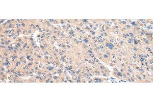 Immunohistochemistry of paraffin-embedded Human liver cancer using VAMP4 Polyclonal Antibody at dilution of 1/30