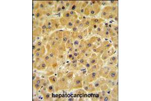 F10 Antibody IHC analysis in formalin fixed and paraffin embedded human hepatocarcinoma followed by peroxidase conjugation of the secondary antibody and DAB staining.