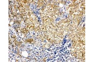 Anti-Vinculin antibody, IHC(P) IHC(P): Human Mammary Cancer Tissue (Vinculin Antikörper  (N-Term))