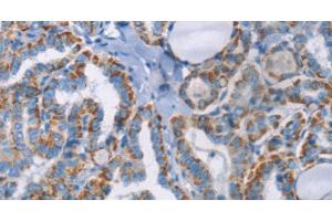 Immunohistochemistry of paraffin-embedded Human thyroid cancer using GPA33 Polyclonal Antibody at dilution of 1:30 (GPA33 Antikörper)