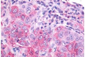 Anti-NMBR antibody IHC staining of human lung, carcinoma.