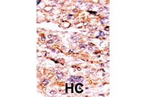 Formalin-fixed and paraffin-embedded human hepatocellular carcinoma tissue reacted with ACVR2A polyclonal antibody  , which was peroxidase-conjugated to the secondary antibody, followed by AEC staining. (ACVR2A Antikörper  (N-Term))