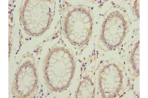 Immunohistochemistry of paraffin-embedded human colon cancer using ABIN7148308 at dilution of 1:100 (COMMD2 Antikörper  (AA 5-199))