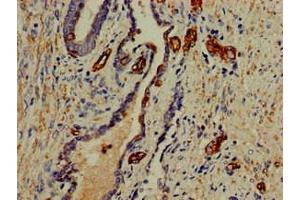 Immunohistochemistry of paraffin-embedded human prostate cancer using ABIN7156227 at dilution of 1:100 (PFAS Antikörper  (AA 1064-1302))