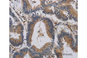 Immunohistochemistry of Human colon cancer using CCR2 Polyclonal Antibody at dilution of 1:20 (CCR2 Antikörper)