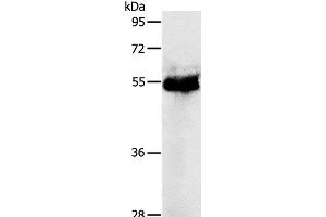Western Blot analysis of Human colon cancer tissue using PRKAR1B Polyclonal Antibody at dilution of 1:1200 (PRKAR1B Antikörper)