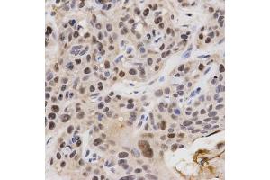 Immunohistochemistry of paraffin-embedded human esophageal cancer using KPNA4 Antibody. (KPNA4 Antikörper)