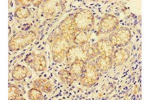 Immunohistochemistry of paraffin-embedded human gastric cancer using ABIN7147004 at dilution of 1:100 (Cathepsin E Antikörper  (AA 59-155))