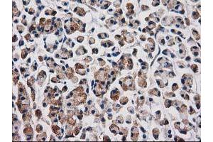 Immunohistochemical staining of paraffin-embedded Adenocarcinoma of Human colon tissue using anti-AQP1 mouse monoclonal antibody. (Aquaporin 1 Antikörper)