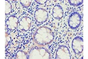 Immunohistochemistry of paraffin-embedded human colon cancer using ABIN7144924 at dilution of 1:100 (ABCE1 Antikörper  (AA 320-599))