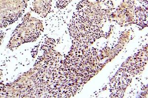 Immunohistochemistry (IHC) analyzes of p-ASK1 antibody in paraffin-embedded human lung adenocarcinoma tissue. (ASK1 Antikörper  (pSer83))