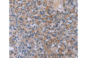 Immunohistochemistry of Human prostate cancer using HSD3B2 Polyclonal Antibody at dilution of 1:50