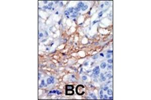 Formalin-fixed and paraffin-embedded human cancer tissue reacted with the primary antibody, which was peroxidase-conjugated to the secondary antibody, followed by AEC staining. (PIP5K1C Antikörper  (C-Term))