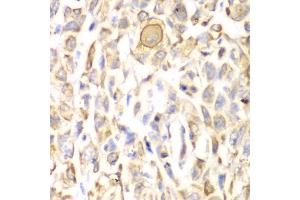 Immunohistochemistry of paraffin-embedded human lung cancer using CD151 antibody. (CD151 Antikörper)