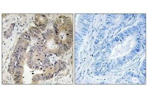 Immunohistochemical analysis of paraffin-embedded human colon carcinoma tissue using CAD (Phospho-Thr456) antibody (left)or the same antibody preincubated with blocking peptide (right). (CAD Antikörper  (pThr456))