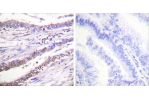 Peptide - +Immunohistochemical analysis of paraffin-embedded human lung carcinoma tissue using Cyclin A antibody (#C0165). (Cyclin A Antikörper)