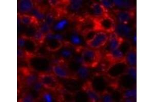 Immunofluorescence analysis of Human lung cancer tissue using COX2 Polyclonal Antibody at dilution of 1:200.