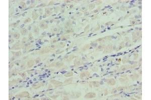 Immunohistochemistry of paraffin-embedded human gastric cancer using ABIN7156368 at dilution of 1:100 (IGFBPI Antikörper  (AA 26-259))
