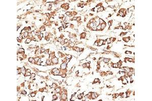 Immunohistochemistry of paraffin-embedded Human mammary cancer using KIR3DS1 Polyclonal Antibody at dilution of 1:100 (40x lens). (KIR3DS1 Antikörper)