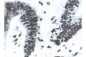 Acetone-fixed, frozen tissue section of human colon carcinoma stained for MLH1 (clone G168-15) using a DAB chromogen and Hematoxylin counterstain. (MLH1 Antikörper)