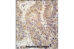 Formalin-fixed and paraffin-embedded human hepatocarcinoma tissue reacted with HARS antibody (N-term) (ABIN391819 and ABIN2841666) , which was peroxidase-conjugated to the secondary antibody, followed by DAB staining. (HARS1/Jo-1 Antikörper  (N-Term))