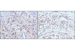Immunohistochemical analysis of paraffin-embedded human lung cancer (left) and gastric cancer (right) using PAK2 antibody with DAB staining.