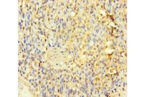 Immunohistochemistry of paraffin-embedded human gastric cancer using ABIN7156759 at dilution of 1:100 (IL1RL2 Antikörper  (AA 20-218))