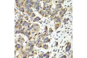Immunohistochemistry of paraffin-embedded human esophageal cancer using SLC25A4 antibody at dilution of 1:100 (400x lens). (SLC25A4 Antikörper)