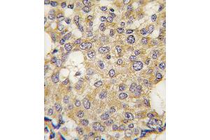Formalin-fixed and paraffin-embedded human breast carcinoma tissue reacted with Parg antibody , which was peroxidase-conjugated to the secondary antibody, followed by DAB staining. (PARG Antikörper  (C-Term))