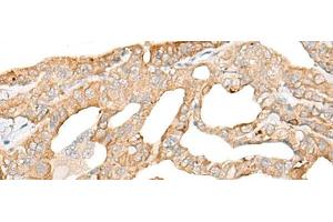 Immunohistochemistry of paraffin-embedded Human thyroid cancer tissue using DDX24 Polyclonal Antibody at dilution of 1:35(x200) (DDX24 Antikörper)